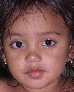 Chickenpox!